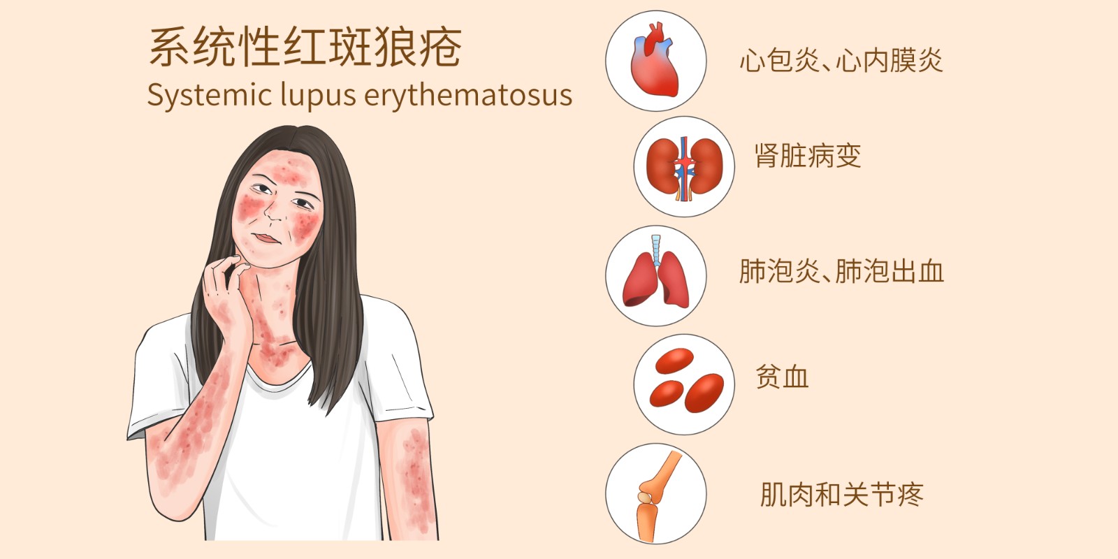 系统性红斑狼疮.jpg